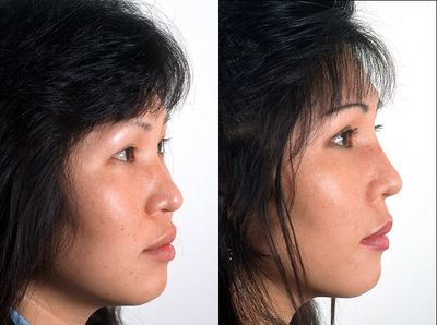 Asian Rhinoplasty before and after photo