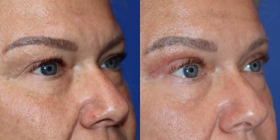 Eyelid Surgery before and after photo
