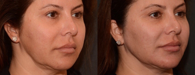 Laser Resurfacing before and after photo