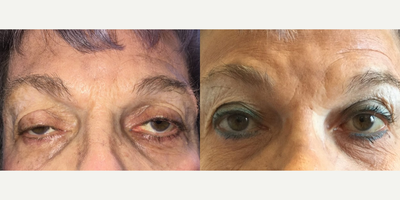 Ptosis Surgery before and after photo
