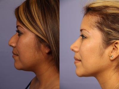 Rhinoplasty before and after photo