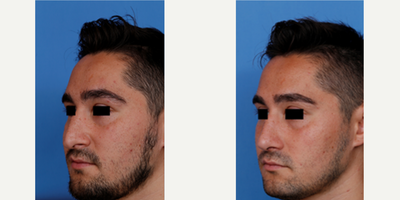 Septoplasty before and after photo
