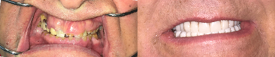 All-on-4 Dental Implants before and after photo