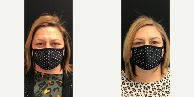 Dermal Fillers before and after photo