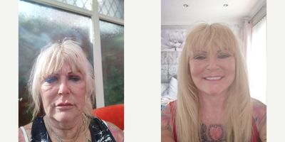 Facelift before and after photo