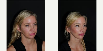 Neck Lift before and after photo