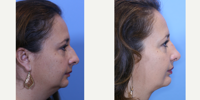 Rhinoplasty before and after photo