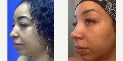 Rhinoplasty before and after photo