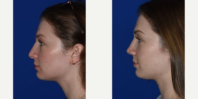 Septoplasty before and after photo