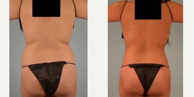 Vaser Liposuction before and after photo