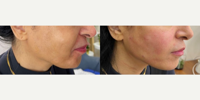 Endolift before and after photo