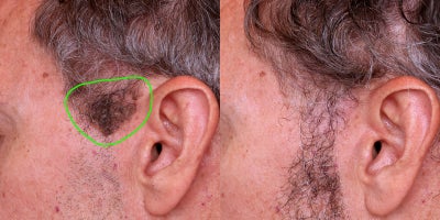 Mole Removal before and after photo