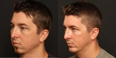 Chin Implant before and after photo