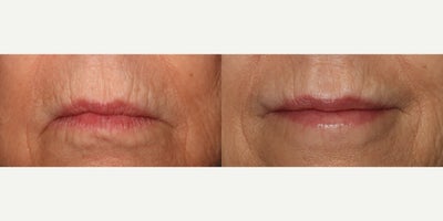 Lip Lift before and after photo
