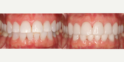 Lumineers before and after photo