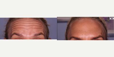 Botox before and after photo