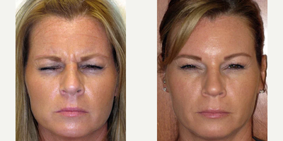 Botox before and after photo
