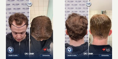Hair Transplant before and after photo