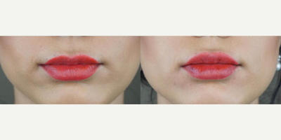 Lip Fillers before and after photo