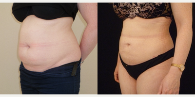 Liposuction before and after photo