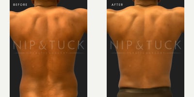 Liposuction before and after photo