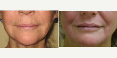 Microdermabrasion before and after photo