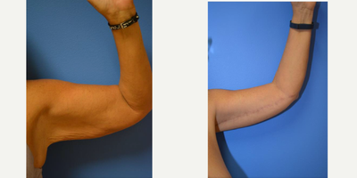 Arm Lift before and after photo