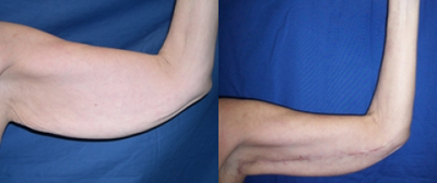 Arm Lift before and after photo