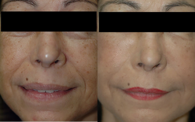 Facial Fat Transfer before and after photo