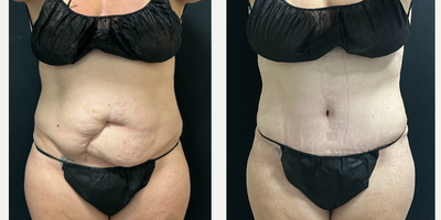 Liposuction before and after photo