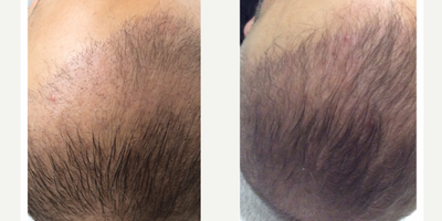 PRP for Hair Loss before and after photo