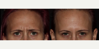 Botox before and after photo