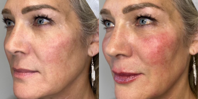 Cheek Fillers before and after photo