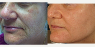 Laser Resurfacing before and after photo