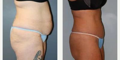 Tummy Tuck before and after photo