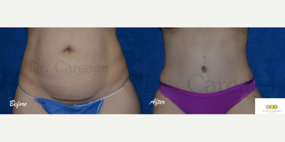 Liposuction before and after photo