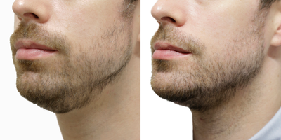Neck Lift before and after photo