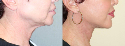 Neck Lift before and after photo