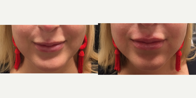 Restylane before and after photo