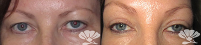 Eyelid Surgery before and after photo