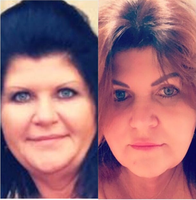 Kybella before and after photo