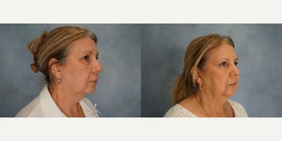 before and after image