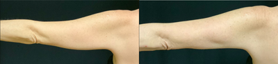 CoolSculpting before and after photo