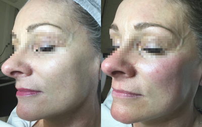 Dermaplaning before and after photo