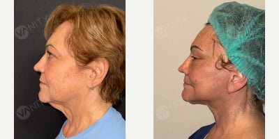 Facelift before and after photo