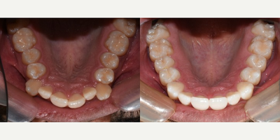 Invisalign before and after photo