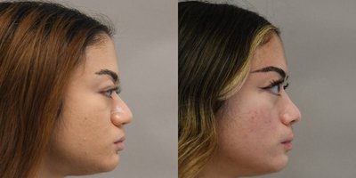 Rhinoplasty before and after photo