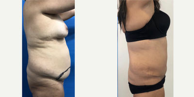 Tummy Tuck before and after photo