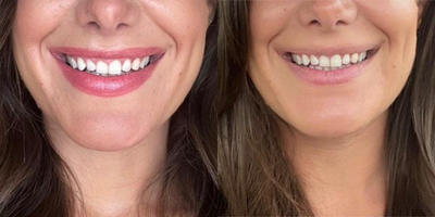Botox before and after photo