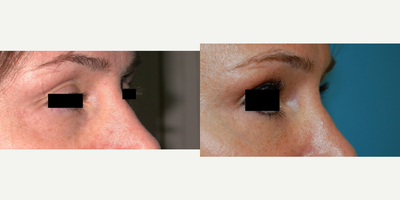 Juvederm before and after photo